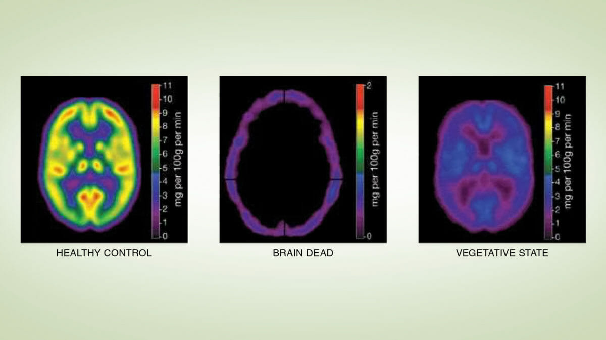 Bid to stop brain test on coma relative