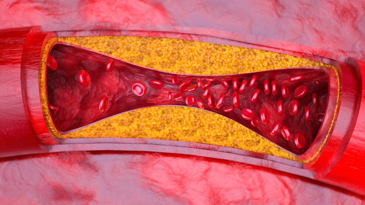 Representación en 3D de una arteria parcialmente obstruida